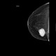 Breast carcinoma, big: MMG - Mammography